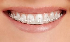 clear braces