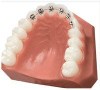 Lingual braces