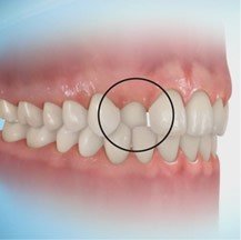 Anterior Crossbite