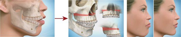 Posterior Maxillary (Top Jaw) Excess with Open Bite