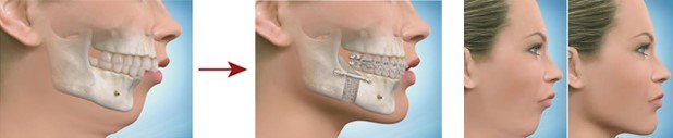 Mandibular (Lower Jaw) Deficiency
