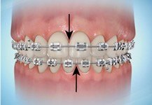 midline assymetry