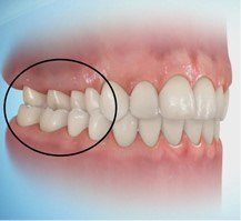 posterior crossbite